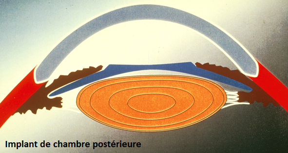 implant-intraoculaire-posterieur