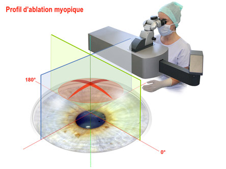 profil-ablation-myopique