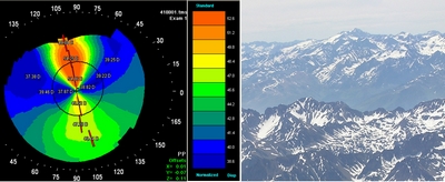 resultat_topographie_corneenne