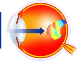 systeme_optique_front_d_ondes_deforme