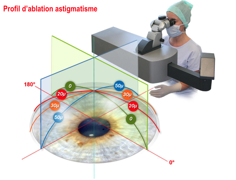 Profil d’ablation astigmatisme