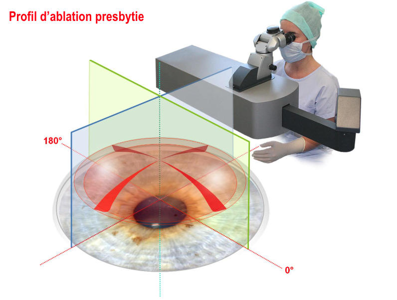 Profil d’ablation presbytie