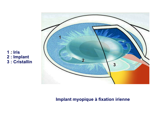 implants-a-fixation-irienne